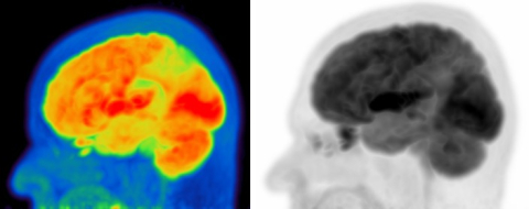 PET/CT-Aufnahme eines Alzheimerpatienten